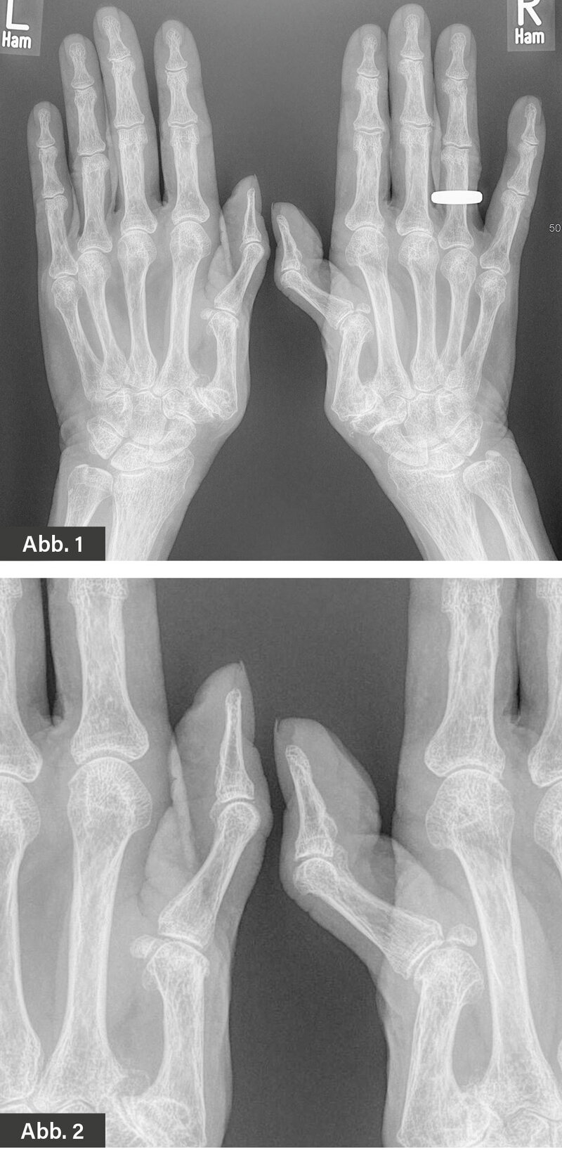 RÖNTGEN: Abb. 1: Hände bds. dorsovolar: 90-90-Deformität (Z-Daumendeformität) Übersicht – als Nebenbefunde Rhiz- und STT-Arthrose sowie beginnende Heberdenarthrose. Abb. 2: Hände bds. dvorsovolar: 90-90-Deformität (Z-Daumendeformität) (Ausschnitt)