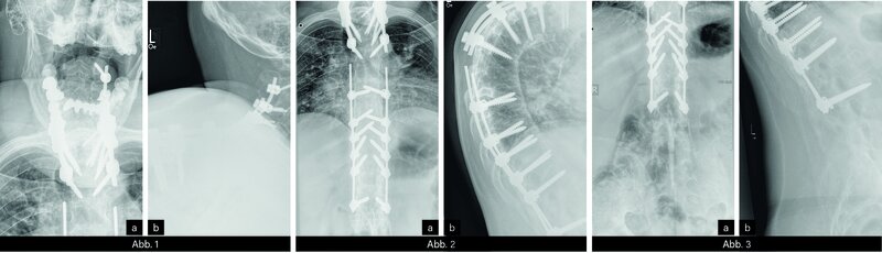 RÖNTGEN: Abb. 1a/b: HWS in 2 Ebenen (ap/seitl.): Z.n. Spondylodese mit Einschluss von HWK 2. Metalldichtes Osteosynthese- und Schraubenmaterial. Steilstellung der soweit beurteilbaren HWS. Wirbelkörper nicht höhengemindert, die Bandscheibenräume soweit einsehbar intakt. Längsbandverkalkung. Abb. 2a/b: BWS in 2 Ebenen (ap/seitl.): Deutlich vermehrte Brustkyphose mit Z.n. Aufrichtoperation mit Spondylodese. Metalldichtes Osteosynthesematerial. Längsbandverkalkung. Einzelne BWK nicht sicher abgrenzbar. Soweit beurteilbar keine Höhenminderungen. Abb. 3a/b: LWS in 2 Ebenen (ap/seitl.) mit ISG: Z.n. Aufrichtoperation mit verbliebenem metalldichtem Osteosynthesematerial bis obere LWK. Vermehrte LWS-Lordose. Soweit beurteilbar Längsbandverkalkung. Fortgeschrittene ISG-Arthrose (Ankylose) Stadium IV.