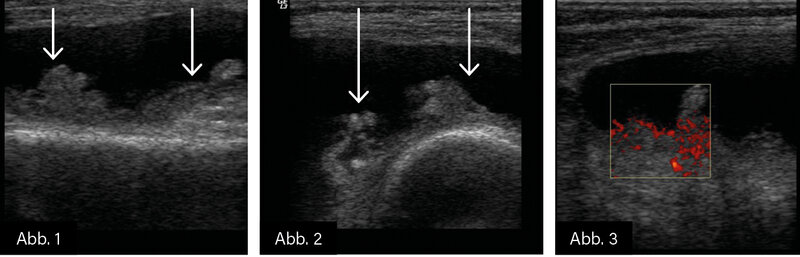 BILDGEBUNG: Abb. 1: Längsschnitt Recessus suprapatellaris linkes Kniegelenk: proliferative Synovialitis bei Gonarthritis im Rahmen einer rheumatoiden Arthritis.  Abb. 2: Querschnitt Recessus suprapatellaris linkes Kniegelenk: proliferative Synovialitis bei Gonarthritis im Rahmen einer rheumatoiden Arthritis. Abb. 3: Querschnitt Recessus suprapatellaris: proliferative Synovialitis mit Nachweis einer aktiven Synovitis im Power-Doppler (PD)