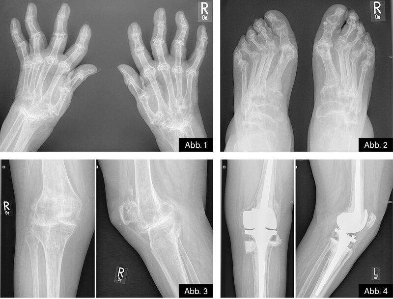 RÖNTGEN: Abb. 1: Hände (dv): fortgeschrittene RA mit (sekundärer) Radiocarpalarthrose, Os carpale bds. sowie destruierende Gelenkveränderungen am allen Fingergrund- und mittelgelenken. Abb. 2: Vorfüße (dp): fortgeschrittene Gelenkdestruktionen an allen Zehengrundgelenken mit (Sekundär-)Arthrosen, Luxationen und Subluxationen. Abb. 3: Kniegelenk rechts ap und seitl.: Fortgeschrittene (sekundäre) Gon- und Retropatellaarthrose. Abb. 4: Kniegelenk links ap und seitl.: Z. n. TEP