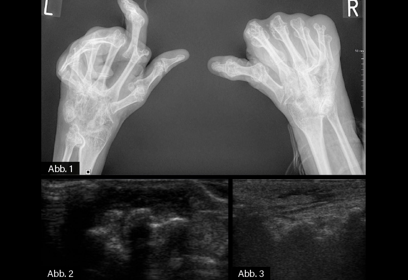 RÖNTGEN UND SONOGRAFIE: Abb. 1: Röntgen Hände bds. dv (1/2023): Fortgeschrittene rheumatoide Arthritis (RA) mit radiokarpaler Ankylose bds. und Ausbildung eines Os karpale. Beugekontrakturen im Bereich D 1-5. Abb. 2/3: Gelenksonografie (1/2023): Längsschnitt dorsal über dem FGG D5 rechts mit Darstellung des Gelenkspalts sowie Gelenkerguss und Synovitis. Querschnitt über dem FGG D5 rechts mit Abszedierung ins periartikuläre Weichgewebe.