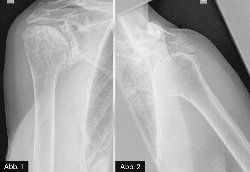 RÖNTGEN: Abb. 1: Rechtes Schultergelenk a.p.: fortgeschrittene Omarthrose mit hochgradiger Gelenkspaltverschmälerung, subkortikalen Geröllzysten im Pfannendachbereich, Verplumpung des Humeruskopfes und vermehrter Sklerose. Abb. 2: Linkes Schultergelenk a.p: fortgeschrittene Omarthrose mit hochgradiger Gelenkspaltverschmälerung und vermehrter Sklerose.