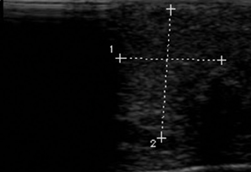 Abb. 2: Gelenksonografie: Längsschnitt über Gichttophus Fingerendglied D4 rechts – umschriebene Struktur mit inhomogener Binnenstruktur – Gichttophus