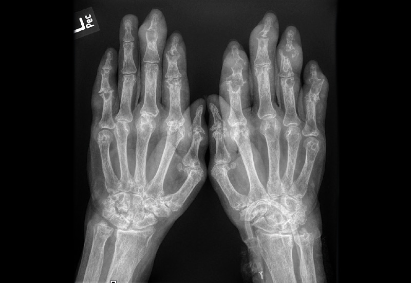 Abb. 3: Röntgen Hände beidseits DV: Destruierende tophöse Arthritis urica mit osteolytischen Knochenveränderungen und Abbildung von Gichttophi