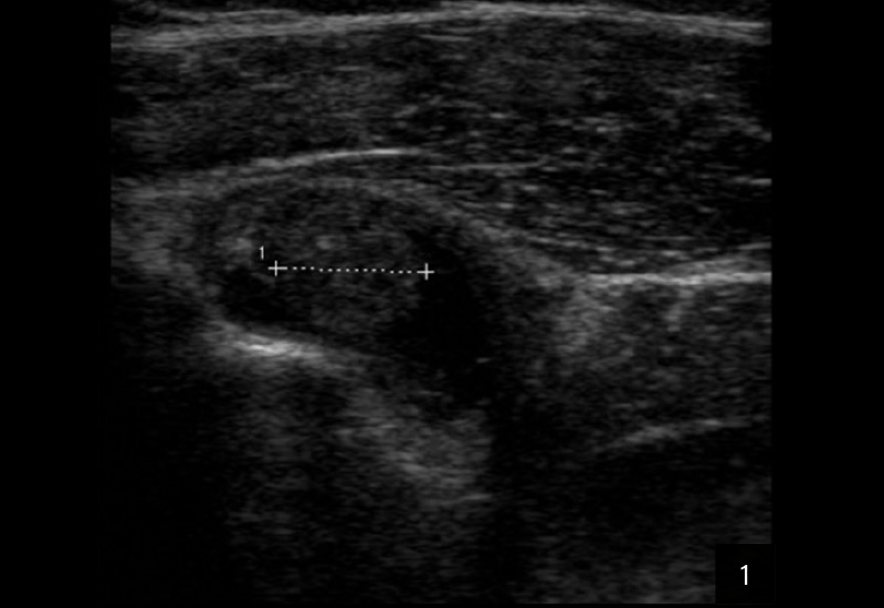 Sonografie linkes Schultergelenk: 1. Querschnitt