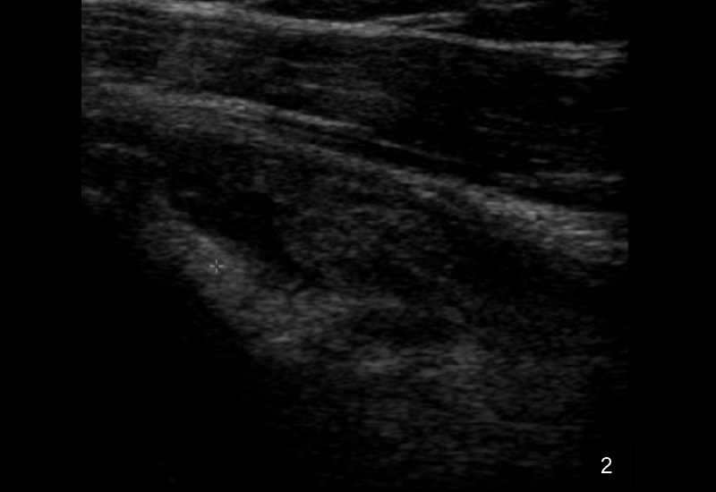 2. Längsschnitt über der verbreiterten langen Bizepssehne mit echoarmen ausgeprägten Halo bei akuter Tenosynovitis.