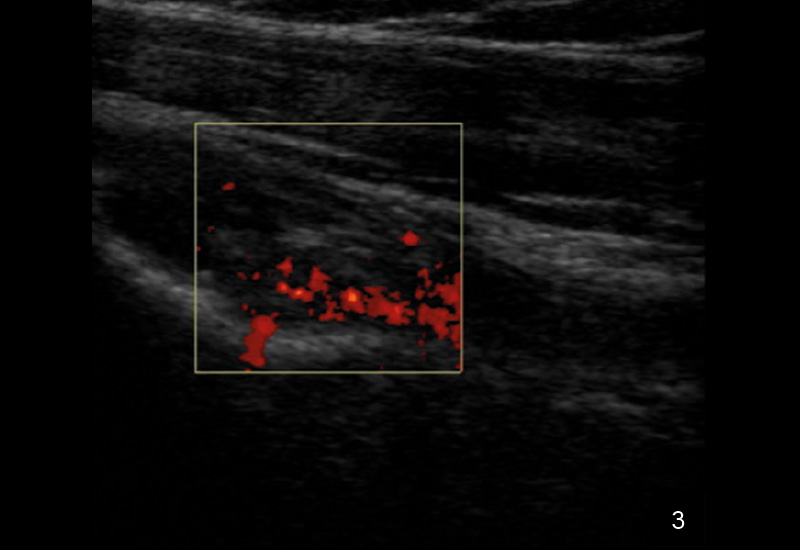 3. Längsschnitt über der langen Bizepssehne mit Power-Doppler. Befund einer klinischen aktiven Tenosynovitis der langen Bizepssehne mit dem Power-Doppler Synovitis Grad II-III.