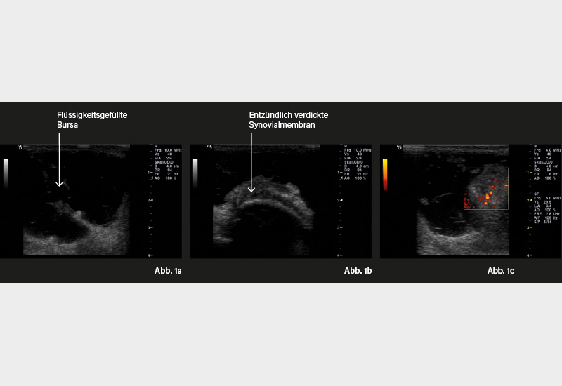 GELENK-/WEICHTEILSONOGRAFIE: Abb. 1a: Längsschnitt rechtes Ellenbogengelenk mit flüssigkeitsgefüllter Bursa, 1b: Querschnitt rechtes Ellenbogengelenk streckseitig mit entzündlich verdickter Synovialmembran, 1c: Längsschnitt rechtes Ellenbogengelenk s GELENK-/WEICHTEILSONOGRAFIE: Abb. 1a: Längsschnitt rechtes Ellenbogengelenk mit flüssigkeitsgefüllter Bursa, 1b: Querschnitt rechtes Ellenbogengelenk streckseitig mit entzündlich verdickter Synovialmembran, 1c: Längsschnitt rechtes Ellenbogengelenk streckseitig mit Powerdoppler und Nachweis einer Synovialitis Grad 2.