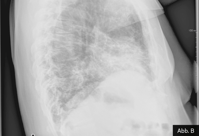 Abb.: Röntgenthorax pa. (A) und seitl. (B): Basale fein- bis grobnetzartige Einlagerungen.