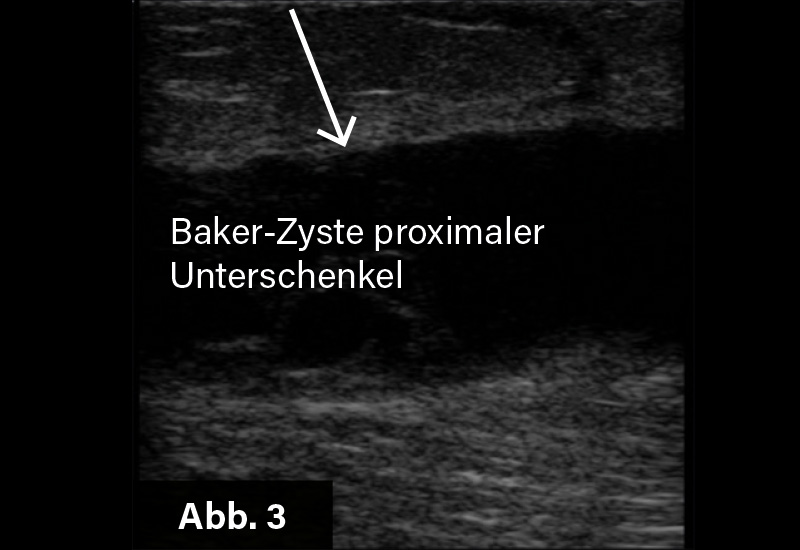 Abb. 3: Längsschnitt proximaler Unterschenkel li.: Voluminöse echofreie abgesackte/rupturierte Baker-Zyste