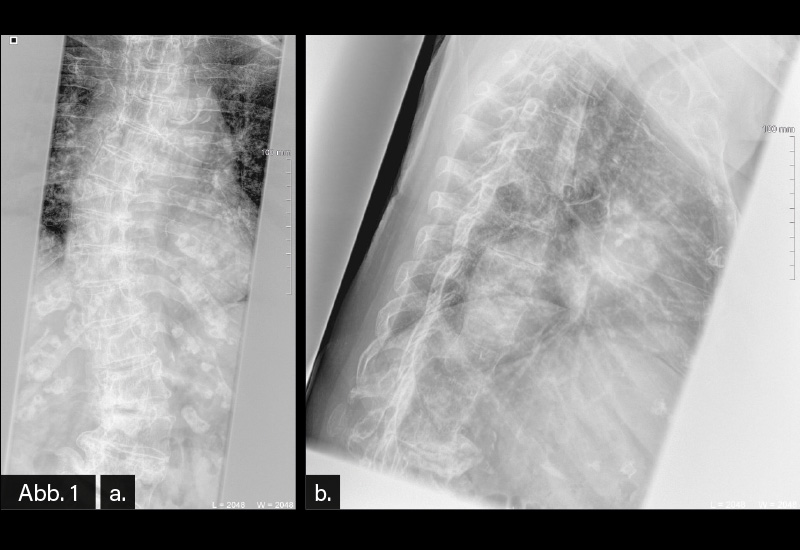 RÖNTGEN: Abb. 1a/b: BWS in zwei Ebenen: Torsionsskoliose rechtskonvex der BWS und linkskonvex der LWS mit Spondylarthrose und Osteochondrose. Osteophytäre Abstützungsreaktionen, insbesondere im Bereich der mitabgebildeten LWS. Beurteilung: Torsionsskoliose. Degenerative Veränderungen der BWS und LWS. 