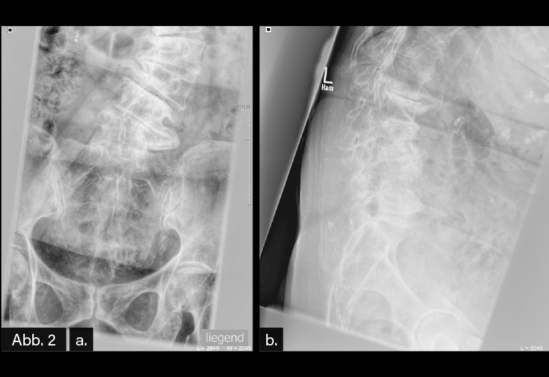 Abb. 2a/b: LWS in 2 Ebenen: Steilstellung der LWS bei Torsionsskoliose. Deutliche Abstützungsreaktionen v. a. im Bereich der unteren LWS. Beurteilung: Torsionsskoliose mit deutlichen Abstützungsreaktionen, v. a. im Bereich der unteren LWS.