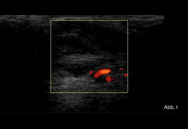 ​​​​​​​GELENKSONOGRAFIE: Abb. 1: Längsschnitt an der distalen Ulna (Processus styloideus ulnae): Tenosynovitis der Sehne des Musculus extensor carpi ulnaris. Im Power-Doppler (7,5 MHz) Nachweis einer aktiven Tenosynovitis.