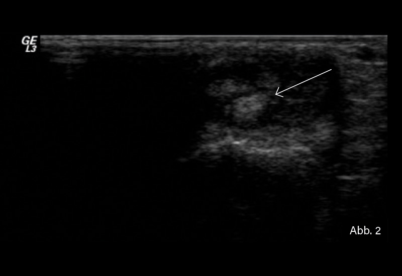 Abb. 2: Querschnitt an der distalen Ulna (Processus styloideus ulnae): Tenosynovitis der Sehne des Musculus extensor carpi ulnaris mit echoarmem Halo um die Sehne des Musculus extensor carpi ulnari.