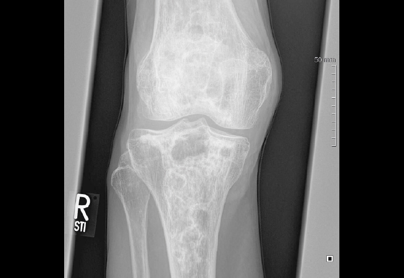Abb. 1a und b: Röntgen Kniegelenke bds pa.: Zeichen der Gonarthrose, vor allem linksseitig mit Gelenkspaltverschmälerung. Gelenknahe zystische Aufhellungen mit vermehrter Sklerose distaler Femur sowie Tibia bds.