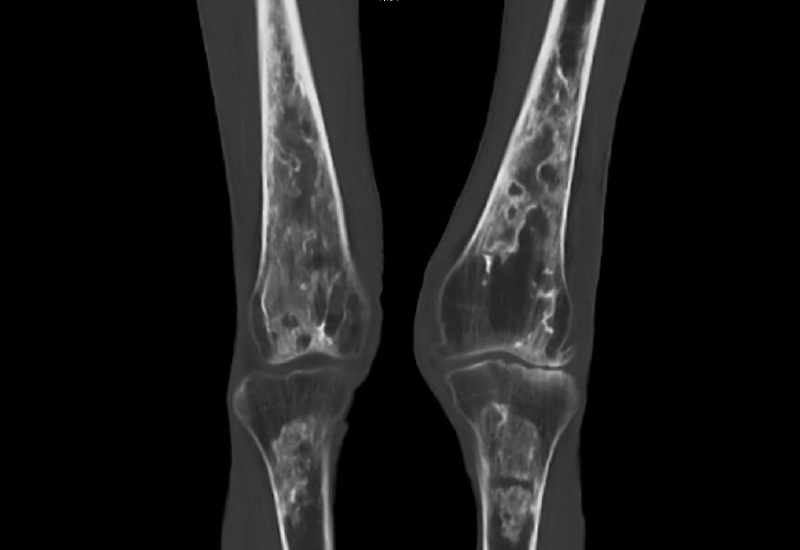 Abb. 2: CT (Knochenfenster) coronar bds.