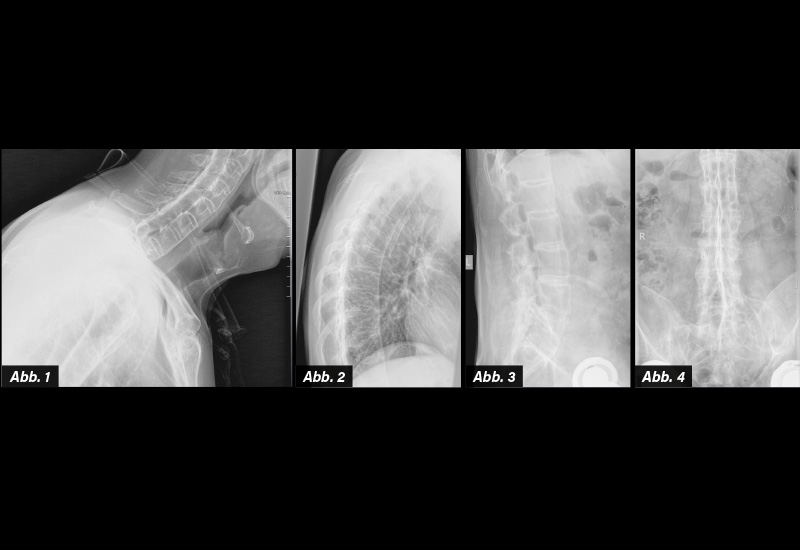RÖNTGEN HWS, BWS, LWS (MIT ISG): Abb. 1: HWS seitlich. Längsbandverkalkung im gesamten Bereich der abgebildeten HWS. Fortgeschrittene AS. Aufgehobene HWS Lordose. Abb. 2: BWS seitlich. Längsbandverkalkungen im gesamten BWS-Bereich. Wirbelkörper nicht höhengemindert. Befund einer fortgeschrittenen AS mit Längsbandverkalkung. Abb. 3: LWS seitlich. Bambusstabartige, überbrückende Syndesmophytenbildung und Längsbandverkalkungen. Wirbelkörper nicht höhengemindert, die Bandscheibenräume intakt. Bandscheibenverkalkungen. Steilstellung. Mit abgebildet TEP Hüftgelenk. Abb. 4: LWS a.p.: Bambusstab. Vollständige Ankylose der ISG bds. (ISG-Arthritis Grad IV). Befund einer fortgeschrittenen AS. Mit abgebildet TEP Hüftgelenke bds.
