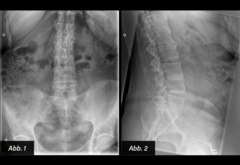 RÖNTGEN: Abb. 1: LWS a.p.: ISG bds. nur eingeschränkt einsehbar. ISG-Arthritis Grad III-IV bds. Abb. 2: LWS seitlich: Bandscheibenverkalkung LWK 3/4, geringe degenerative Veränderungen im thorakolumbalen Übergangsbereich.