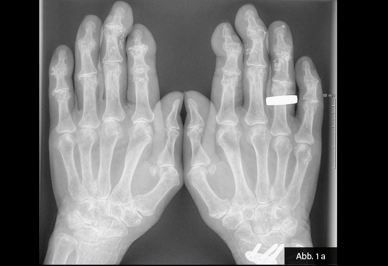 ​​​​​​​RÖNTGEN: Abb. 1 a: Röntgen Hände; Dorso-volar: Weichteilverkalkungen (Calcinosis cutis D3 links sowie D3 und 4 rechts. Polyarthrose mit strukturellen Gelenkveränderungen; Z.n. distaler Radiusfraktur mit abgebildetem Osteosynthesematerial.