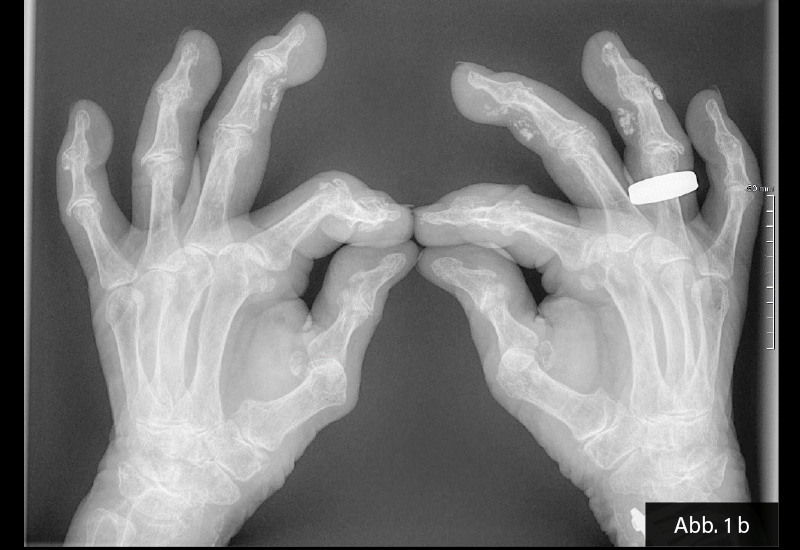 Abb. 1 b: schräg seitlich bds.