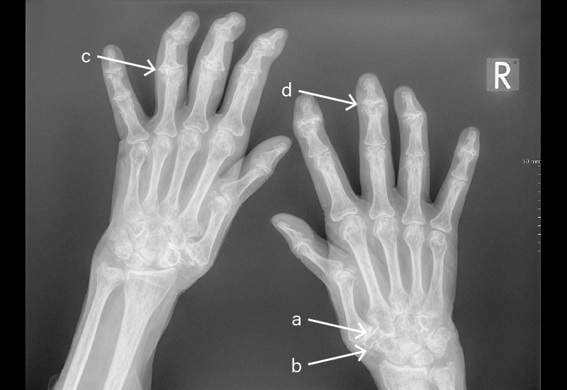 RÖNTGEN: Abb.: Hände bds. dv (11/2022), a. Rhizarthrose, b. STT-Arthrose, c. Bouchard-Arthrose (destruierend), d. Heberden-Arthrose (destruierend). Bds. beginnende Radiokarpalarthrose sowie fortgeschrittene Rhiz- und STT-Arthrose bds. Gelenkspaltverschmälerung an den Fingergrund-/Fingermittel- und insbesondere Fingerendgelenken. Im Fingerendgelenksbereich auch strukturelle Veränderungen mit Fehlstellungen. Befund mit fortgeschrittener Fingerpolyarthrose vereinbar.