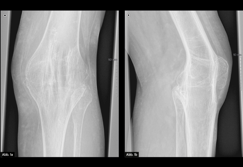 RÖNTGEN: Abb.: Röntgen Kniegelenk links in zwei Ebenen: 1a. ap, 1b. seitlich: Vollständige Ankylose des linken Kniegelenks ohne nachweisbarem Gelenkspalt bei Z.n. tuberkulöser Arthritis